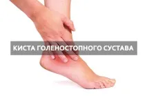 Як лікувати кісту тазостегнового, ліктьового, плечового та інших суглобів народними засобами кісту