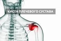 Як лікувати кісту тазостегнового, ліктьового, плечового та інших суглобів народними засобами кісту