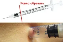 Як витягти кліща самостійно самостійно