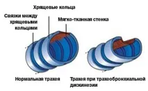 Чим лікувати кашель при трахеїті? кашлю трахеїті