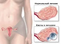 Кіста яєчника чи можливе лікування без операції, народними засобами кіста