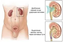 Лазерне та ультразвукове видалення каменів у нирках за кордоном видалення