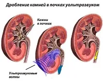 Лазерне та ультразвукове видалення каменів у нирках за кордоном видалення