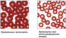 Низький гемоглобін при вагітності наслідки для дитини вагітності