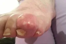 подагри