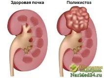 Полікістоз нирок ознаки, діагностика та всі способи лікування лікування