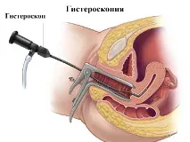 Поліпи в матці поліпи ендометрію та поліпи шийки матки шийки