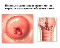 Поліпи в матці поліпи ендометрію та поліпи шийки матки матці