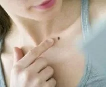 Причини та види родимок може