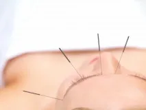 акупунктурою