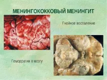 Ознаки та симптоми менінгіту у дітей наслідки, лікування, інкубаційний період ознаки