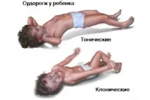 Судоми – судоми у дітей судоми