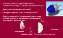 Ударно-хвильова терапія ударно-хвильова