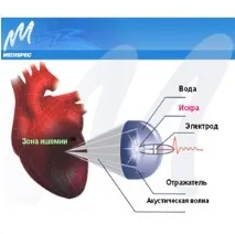 Ударно-хвильові системи Кардіоспек лікування