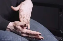 Вітіліго, симптоми та лікування вітіліго шкіри