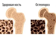 Виявлення остеопорозу кістки шляхом оцінювання структури трабекулярної тканини. виявлення