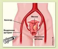 Емболізація маткових артерій (ЕМА) маткових