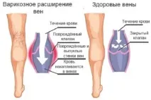 Хвороби судин ніг 8 симптомів, які змушують бити на сполох судин