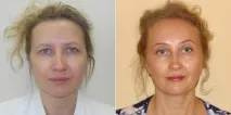 Брови вгору! Втомлений та похмурий вигляд усуне броуліфт! брови