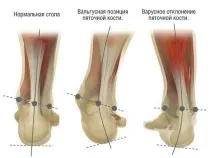 Деформація стопи вальгусна види та лікування деформація
