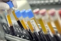 Якщо у чоловіка жовта сперма може