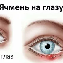 Ефективна змова від ячменю - Vip Ezoterika ячмінь