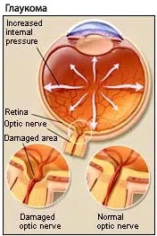 глаукома