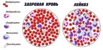 Яка дієта при лейкозі допоможе прискорити одужання дієта