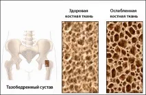 Як уникнути остеопорозу уникнути
