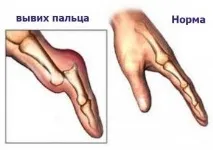 Як лікувати вивих пальця на руці чи нозі вивих