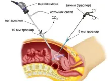 Як відбувається операція при ендометріозі матки матки