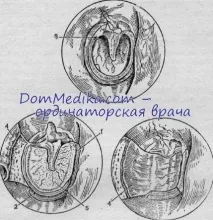Трансплантація барабанної перетинки трансплантація
