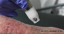 Шкірні захворювання - як можуть допомогти народні засоби шкірні