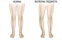 Кісткова хвороба педжета симптоми, лікування та ускладнення, фото хвороба