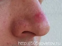 Червоніє ніс на морозі носа