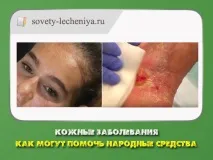 Шкірні захворювання - як можуть допомогти народні засоби захворювання