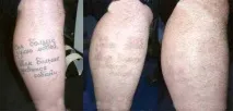 Лазерне видалення татуювань у Криму виведення татуювання Алушта, linline видалення татуювань, лазерне