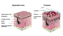 Лікування псоріазу в домашніх умовах псоріазу