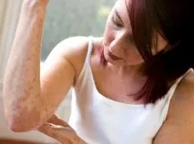 Лікування псоріазу в домашніх умовах домашніх