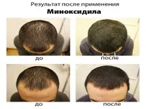 міноксидил