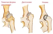 Ортез Тюбінгера опис пристосування та докладна інструкція до застосування пристосування