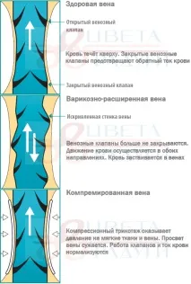 Як діє медичний компресійний трикотаж трикотаж