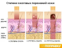 Опіки перша допомога, лікування, ступеня. перша