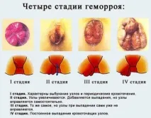 Папаверин при геморої відгуки та інструкція застосування застосування