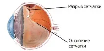 Розрив сітківки ока – причини, симптоми та лікування сітківки
