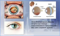 Розрив сітківки ока – причини, симптоми та лікування розрив