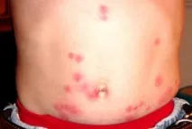Дитину покусали блохи, що робити, як лікувати робити