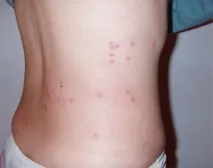 Дитину покусали блохи, що робити, як лікувати дитину
