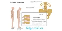 анкилозиращ