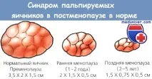 Синдром яєчників, що пальпуються після клімаксу (постменопаузи) пальпуються